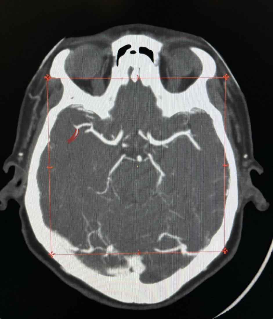 AngioTC de cerebro con mediciones