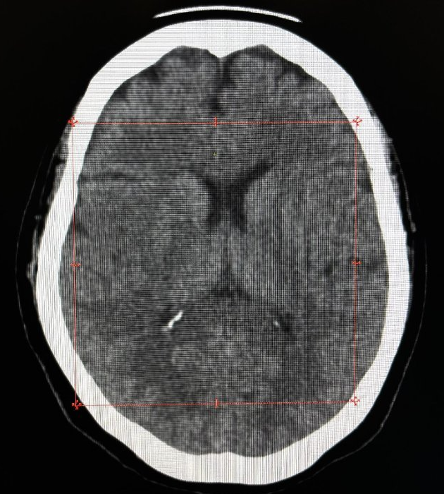 Tomografía computada de cerebro sin contraste con mediciones