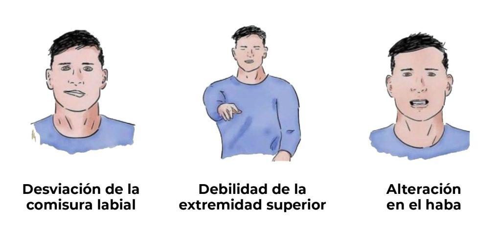 Los tres signos de la escala de Cincinnati: desviación de la comisura labial, debilidad de la extremidad superior y alteración en el habla