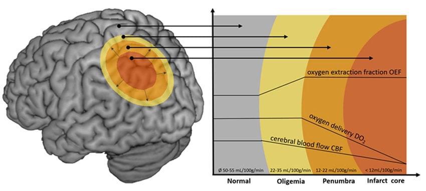 Núcleo de infarto, penumbra y oligemia